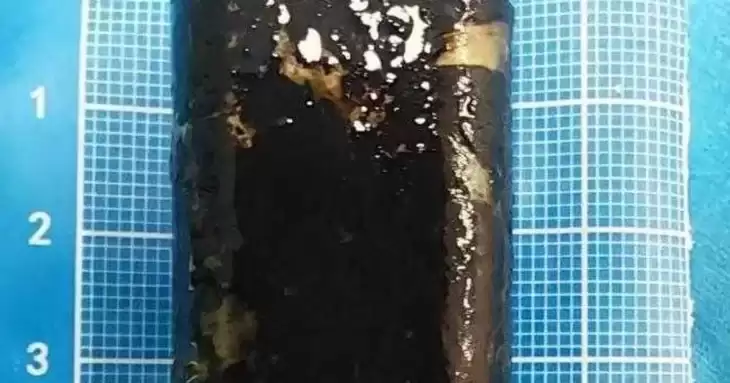 Вона все ще працювала: чоловік прожив 30 років із запальничкою у шлунку