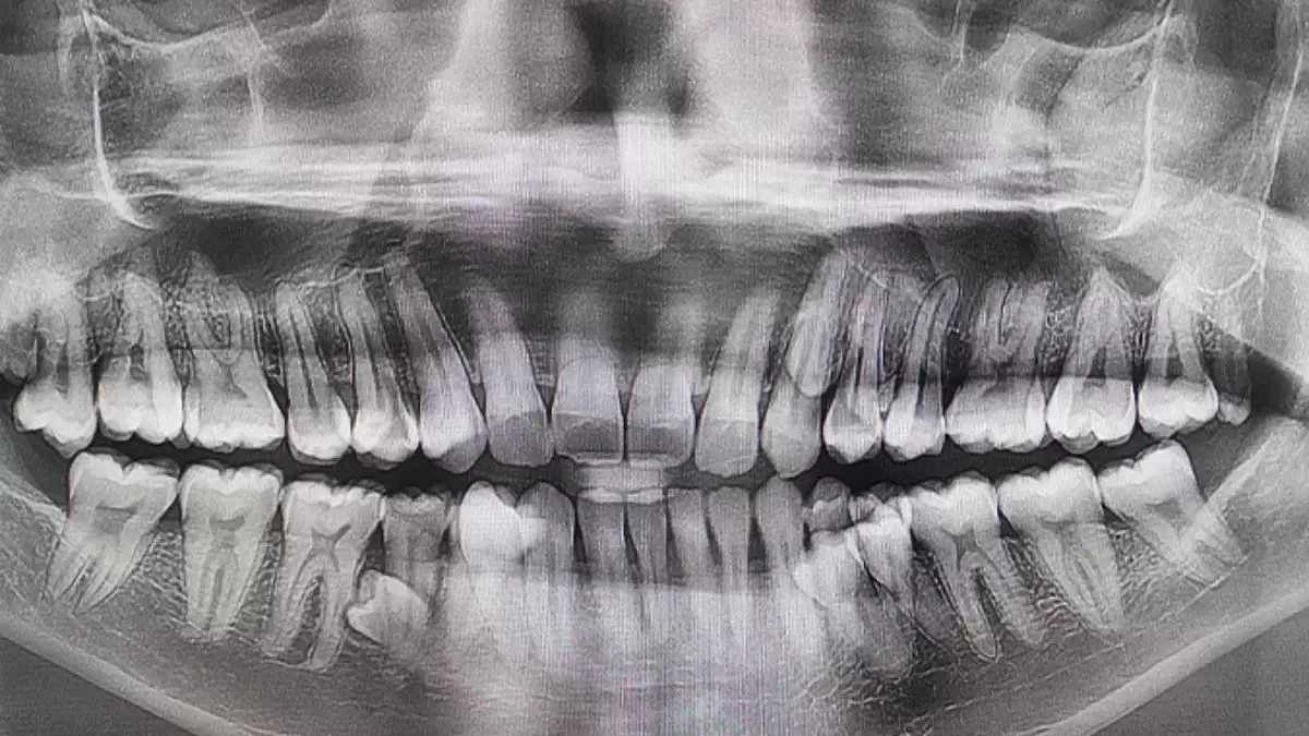 Ото посмішка: у цього чоловіка рекордна кількість зубів: на 10 більше, ніж вважається для людини нормою