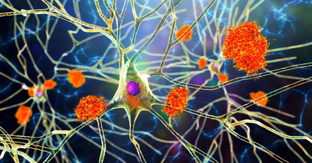 Болезнь Альцгеймера оказалась генетическим заболеванием: ученые обнаружили новый ген
