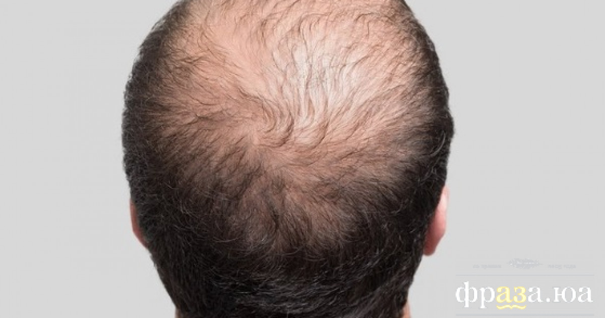 Ученые придумали новый способ борьбы с облысением