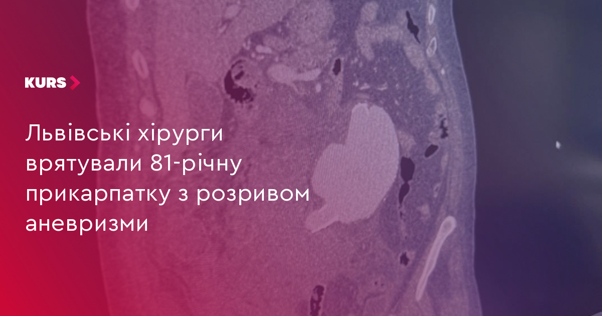 Львівські хірурги врятували 81-річну прикарпатку з розривом аневризми