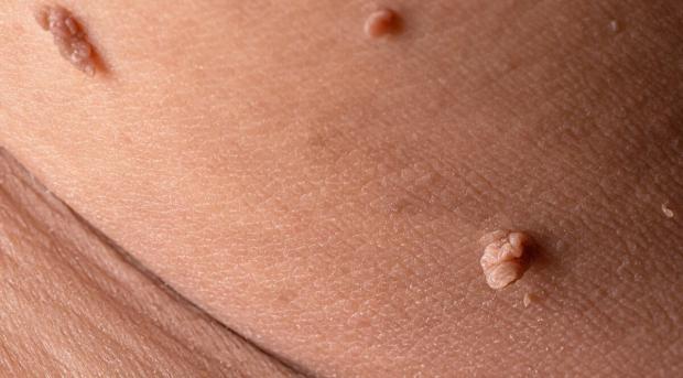 Вірус папіломи людини: Це не тільки косметична проблема. Як протидіяти легко і ефективно