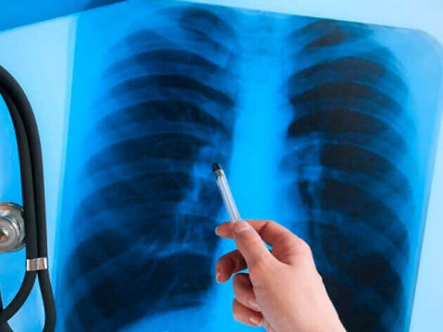 У Волинській області за два місяці на туберкульоз захворіли 169 людей