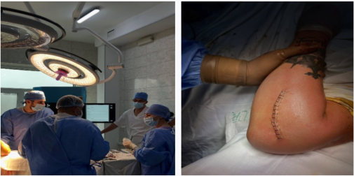 Диво медицини: у Нововолинську медики відновили руку чоловіку після надскладного перелому (фото 18+)