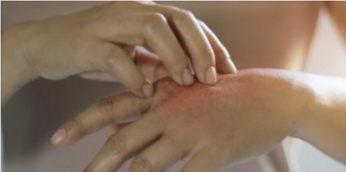 У масажисток в спа-салоні: в Румунії вперше за понад 40 років зафіксували випадки прокази