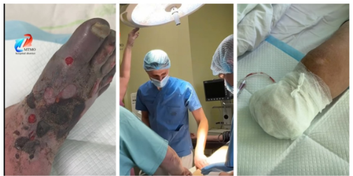 Зволікав зі зверненням до медиків: у Ковелі чоловіку ампутували обморожену ногу (відео)