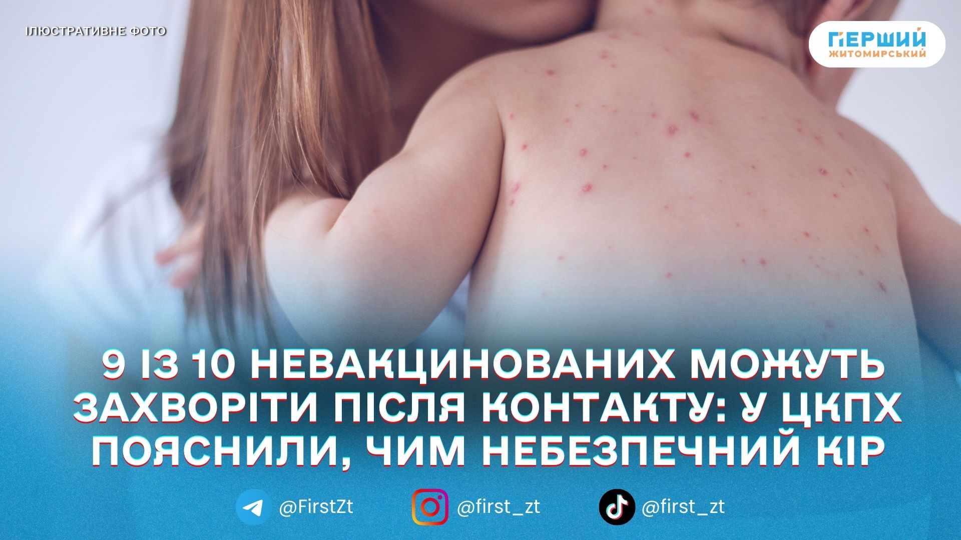 Житомирський ЦКПХ нагадав: кір — надзаразний, захист дає вакцинація у 1 та 4 роки