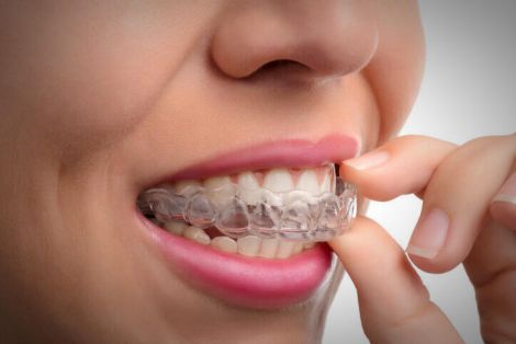 У яких випадках брекети можна замінити елайнерами