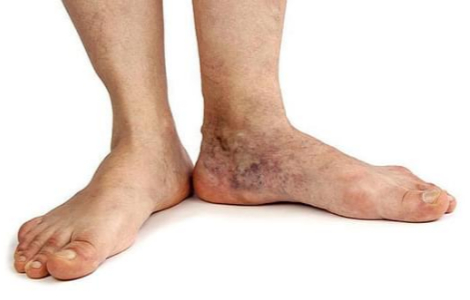 Чому виникає трофічна виразка