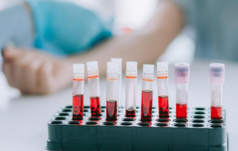 Як підготуватися до біохімічного аналізу крові