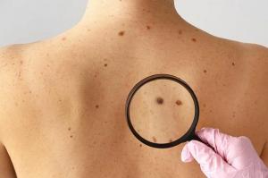 Рак шкіри: рівнян запрошують перевірити родимки