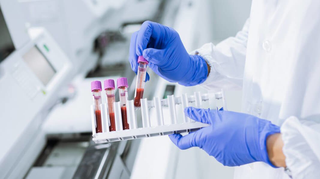 В июне в Николаевской области зарегистрировали 28 новых случаев ВИЧ-инфекции