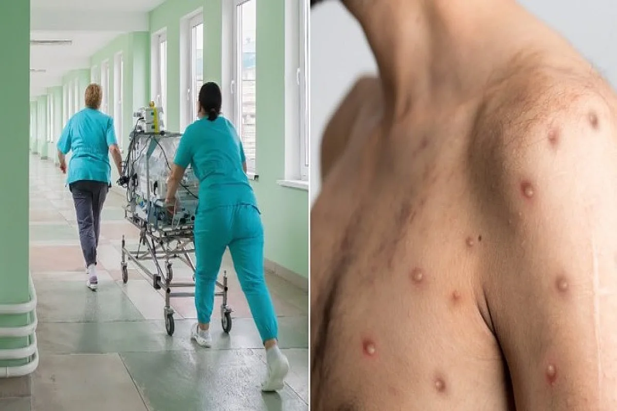 В России вновь зафиксировали оспу обезьян: в Санкт-Петербурге госпитализировали четырех человек