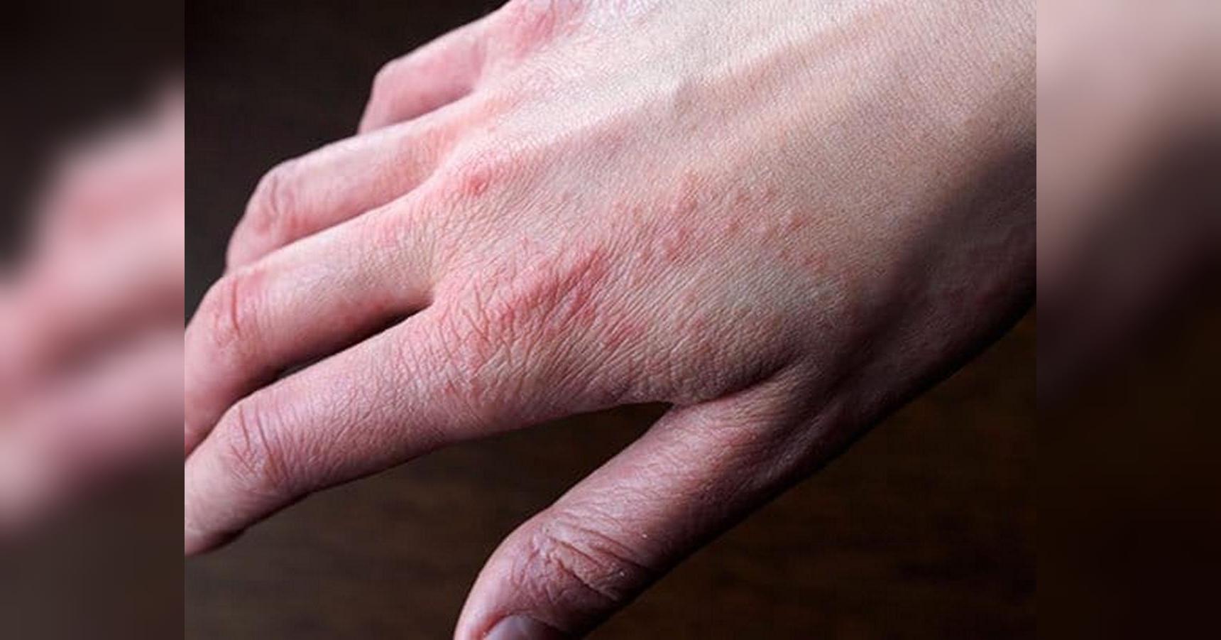 Зудящая сыпь после пребывания на холоде: это может быть тревожным сигналом