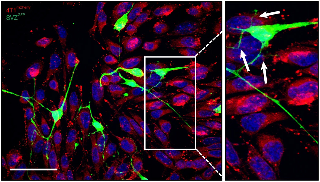 Нейроны «подкармливают» рак, снабжая клетки опухоли митохондриями