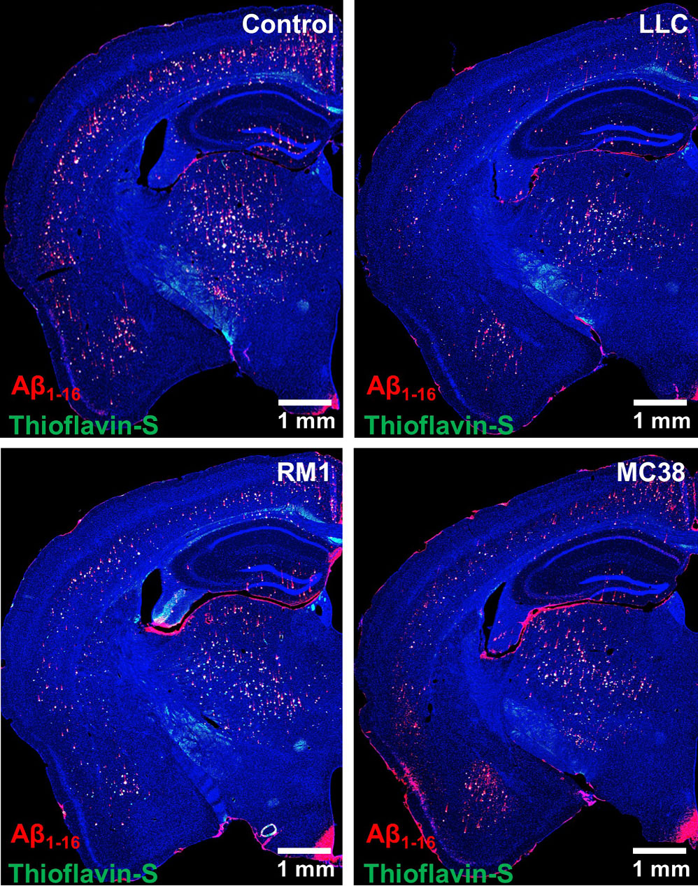 Рак против Альцгеймера: белок цистатин C активирует растворение амилоидных бляшек